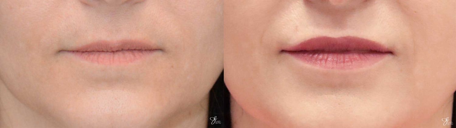 Lip Filler Before & After