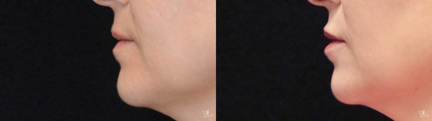 Lip Filler Before & After
