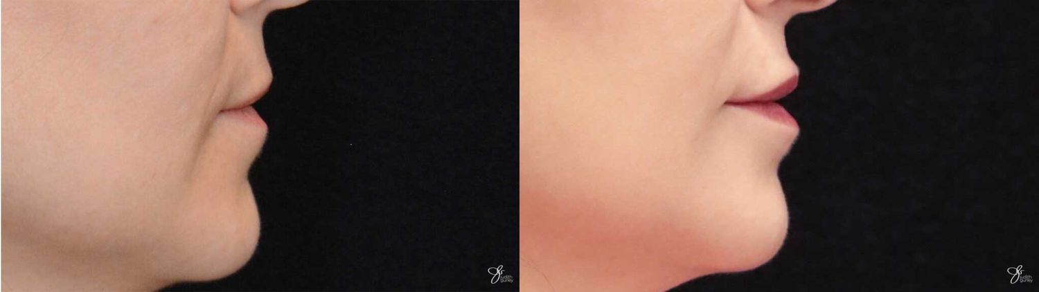 Lip Filler Before & After