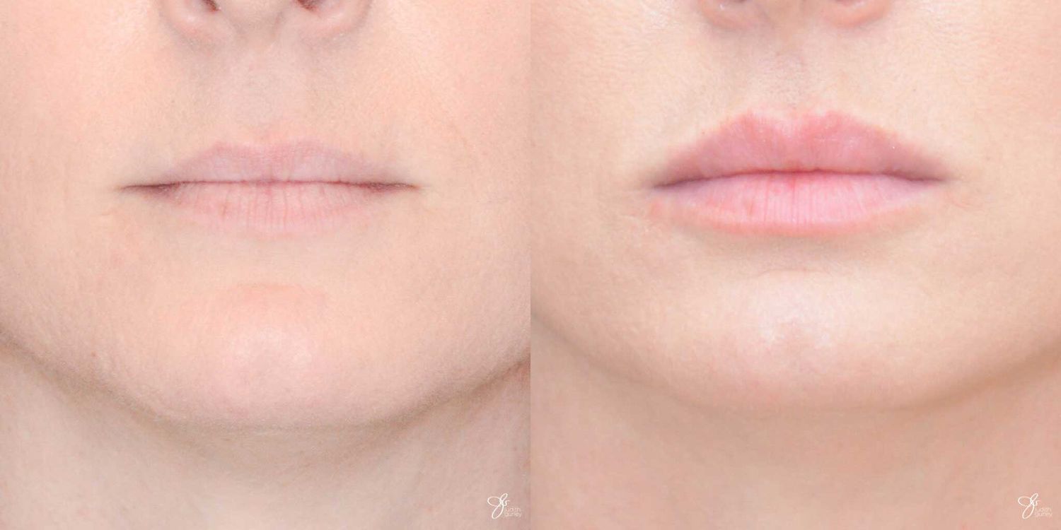 Lip Filler Before & After