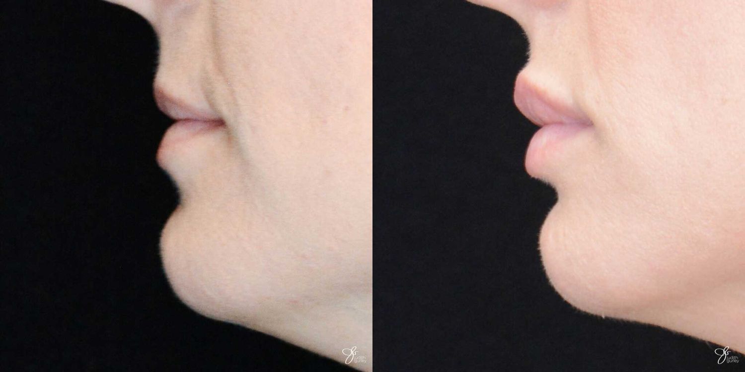 Lip Filler Before & After