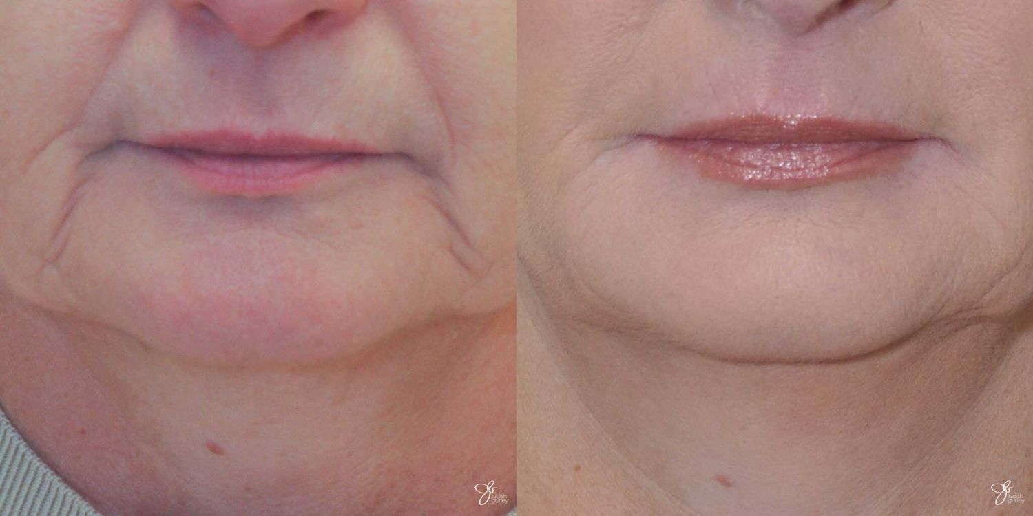 Lip Filler Before & After