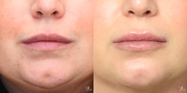 Lip Filler Before & After