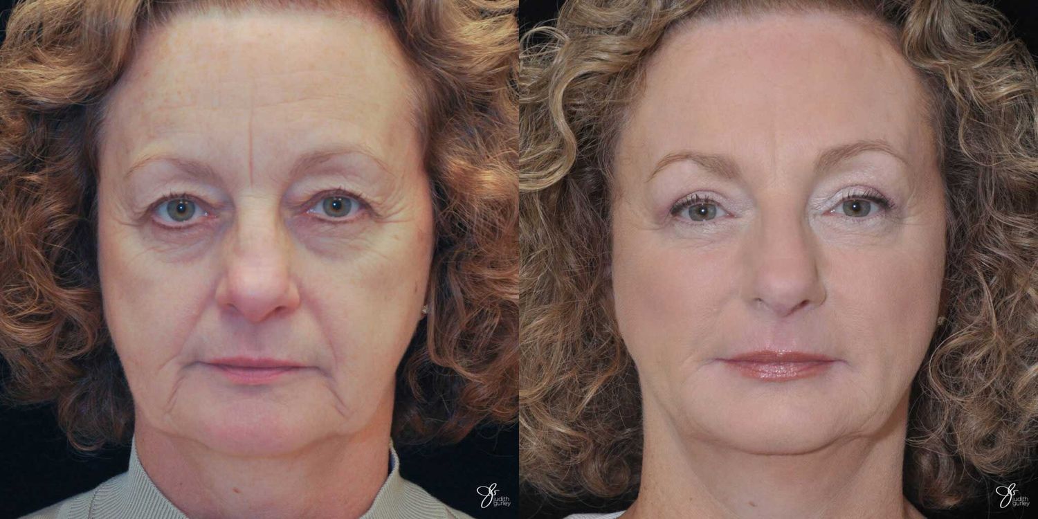 Facial Liposuction Before & After