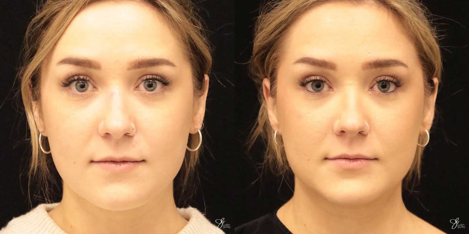 Facial Liposuction Before & After