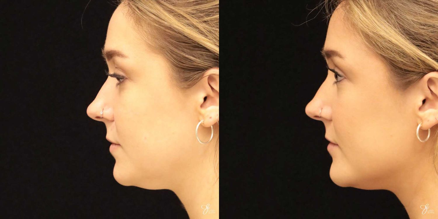Facial Liposuction Before & After