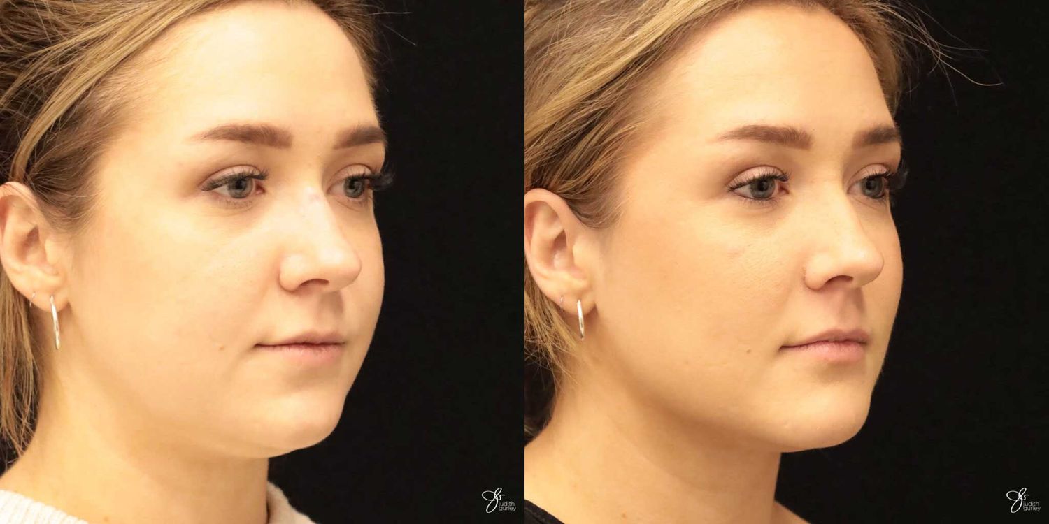 Facial Liposuction Before & After