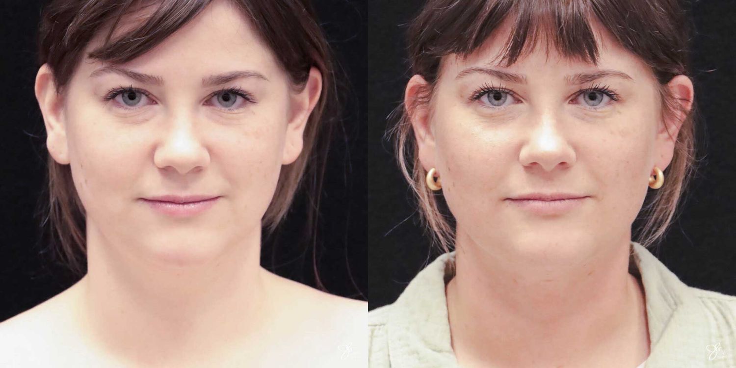Facial Liposuction Before & After