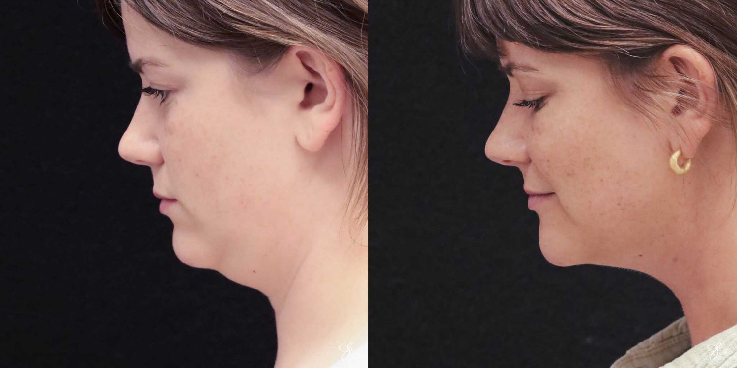 Facial Liposuction Before & After