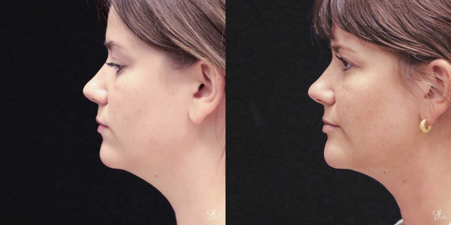 Facial Liposuction Before & After