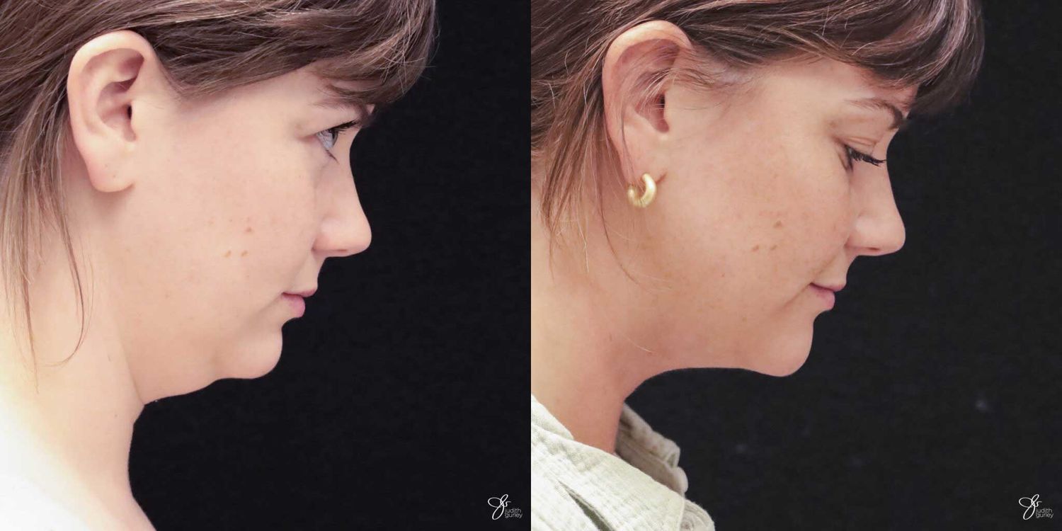 Facial Liposuction Before & After