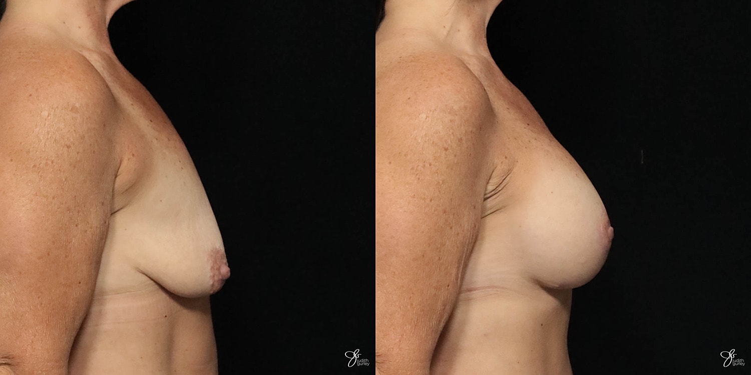 Breast Augmentation And Lift Before & After