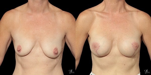 Breast Augmentation And Lift Before & After