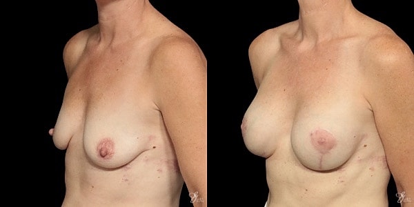 Breast Augmentation And Lift Before & After