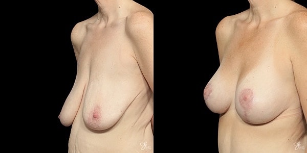 Breast Augmentation And Lift Before & After