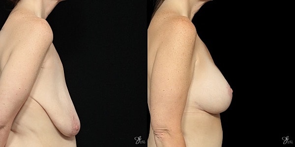 Breast Augmentation And Lift Before & After