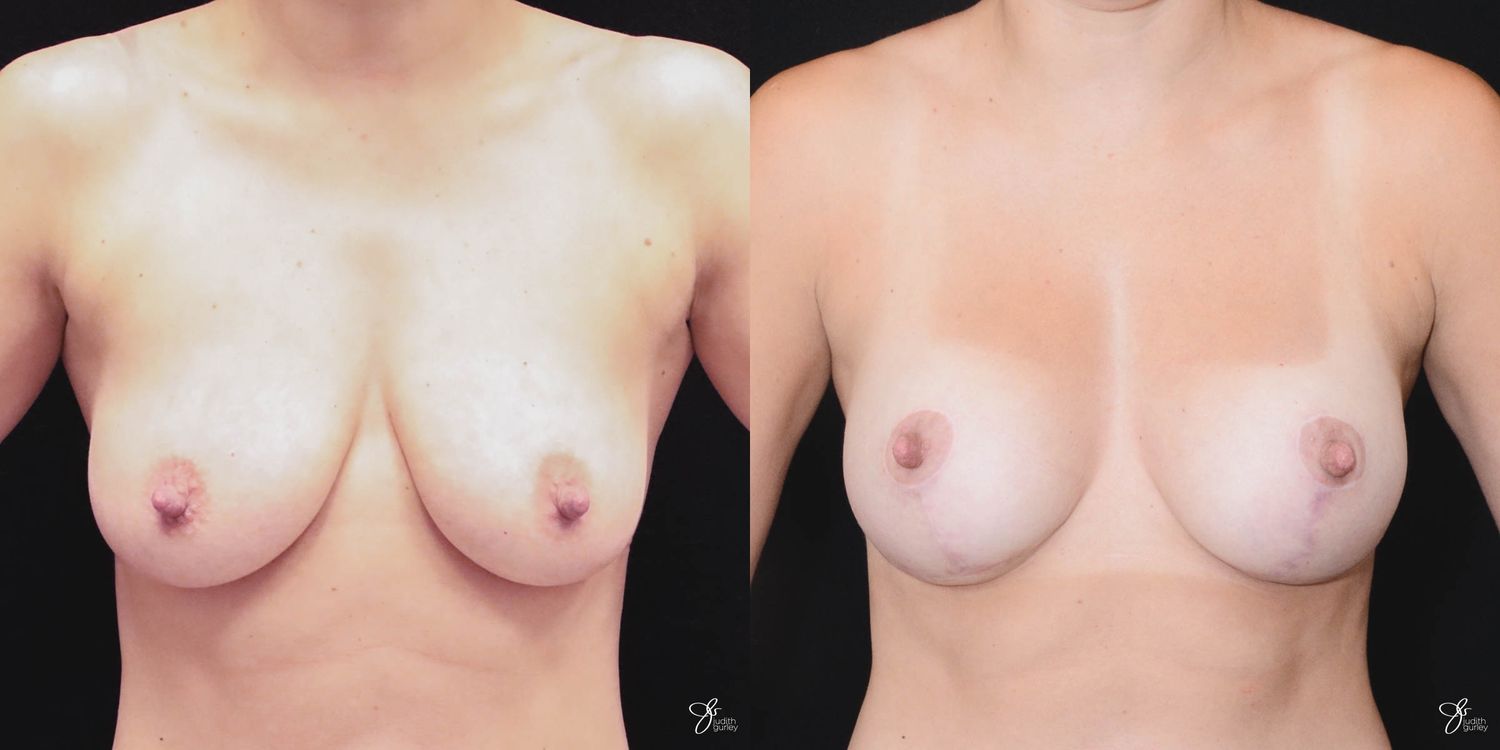 Breast Augmentation And Lift Before & After