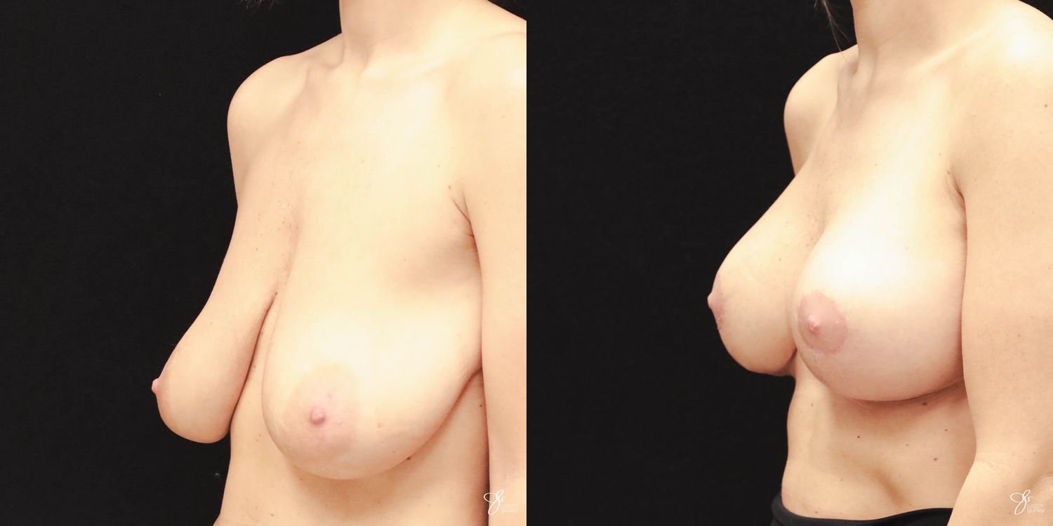 Breast Augmentation And Lift Before & After