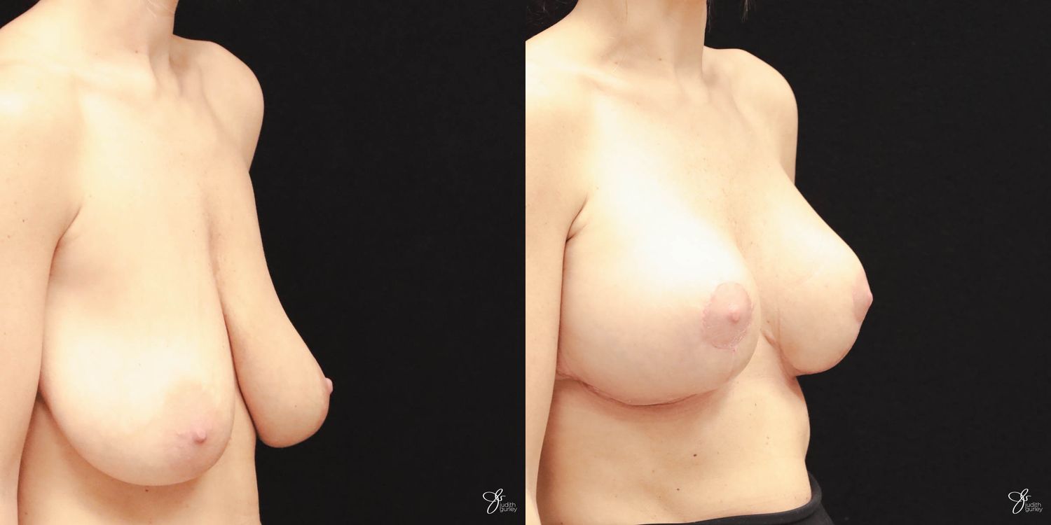 Breast Augmentation And Lift Before & After