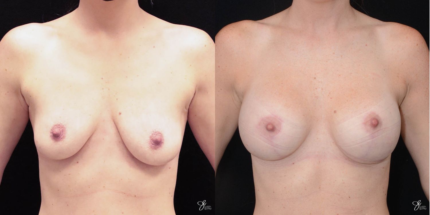 Breast Augmentation And Lift Before & After