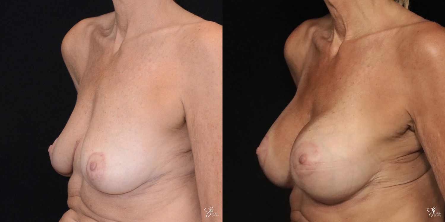 Breast Augmentation And Lift Before & After