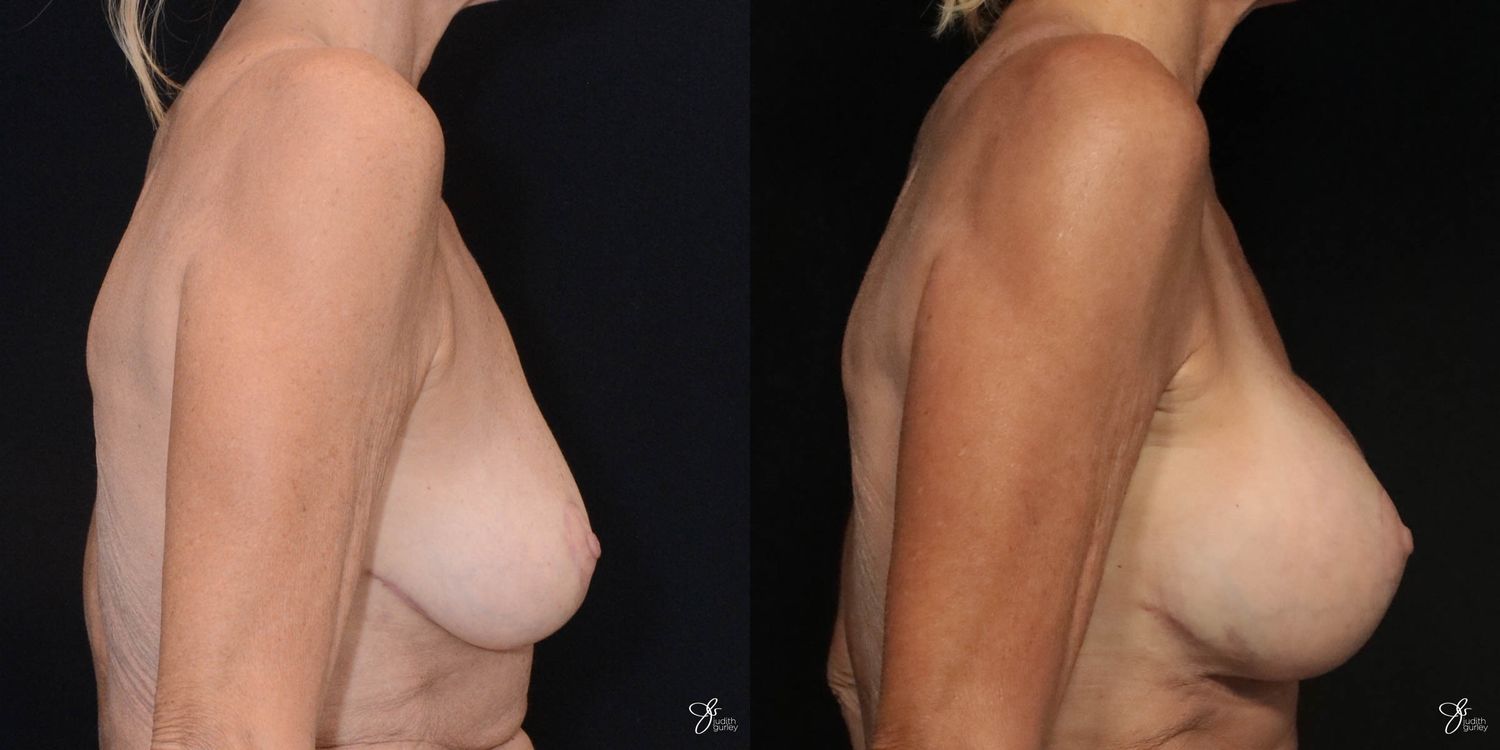 Breast Augmentation And Lift Before & After