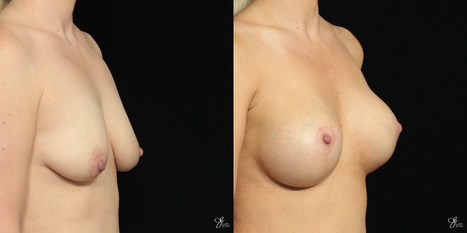 Breast Augmentation And Lift Before & After