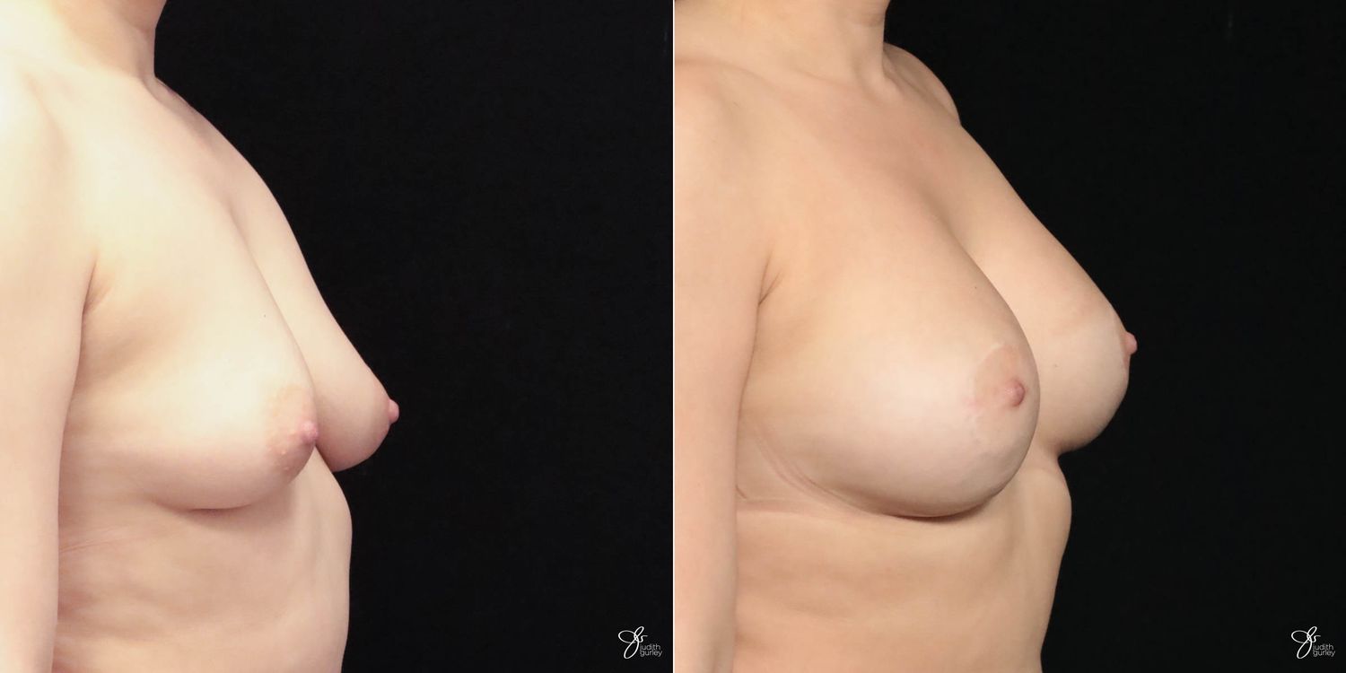 Breast Augmentation And Lift Before & After