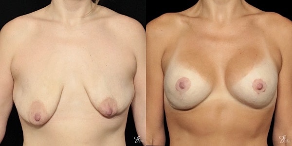 Breast Augmentation And Lift Before & After