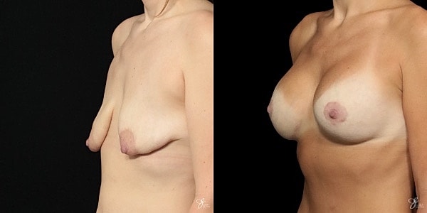 Breast Augmentation And Lift Before & After