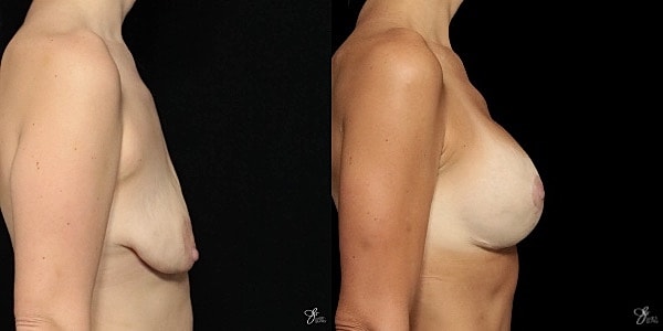 Breast Augmentation And Lift Before & After