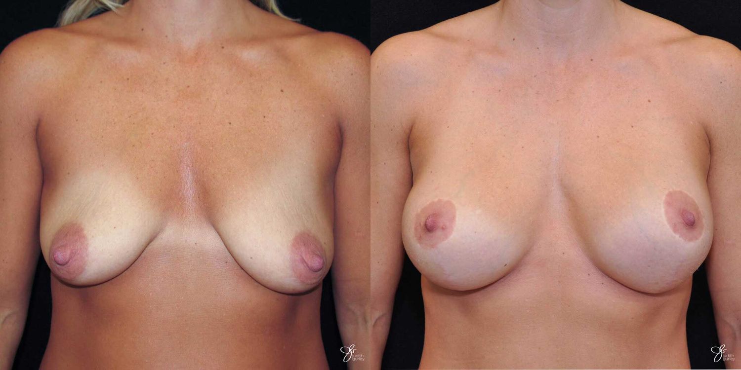 Breast Augmentation And Lift Before & After