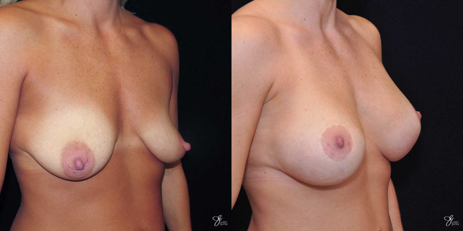 Breast Augmentation And Lift Before & After