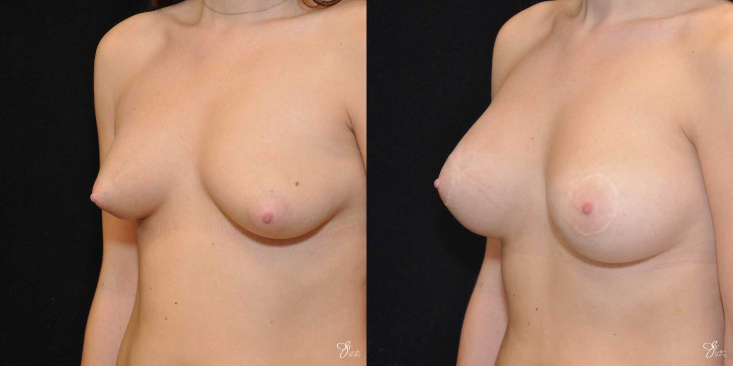Breast Augmentation And Lift Before & After