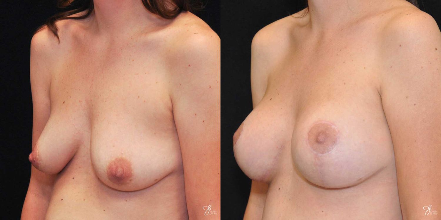 Breast Augmentation And Lift Before & After