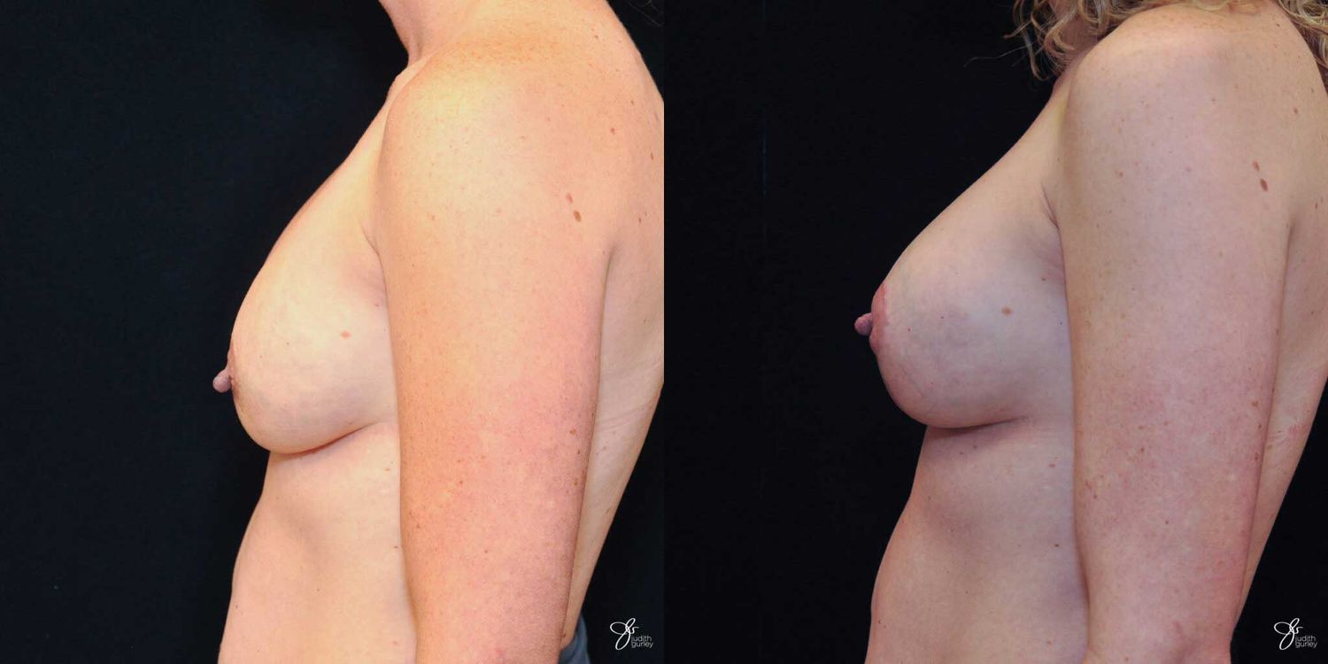 Breast Augmentation And Lift Before & After