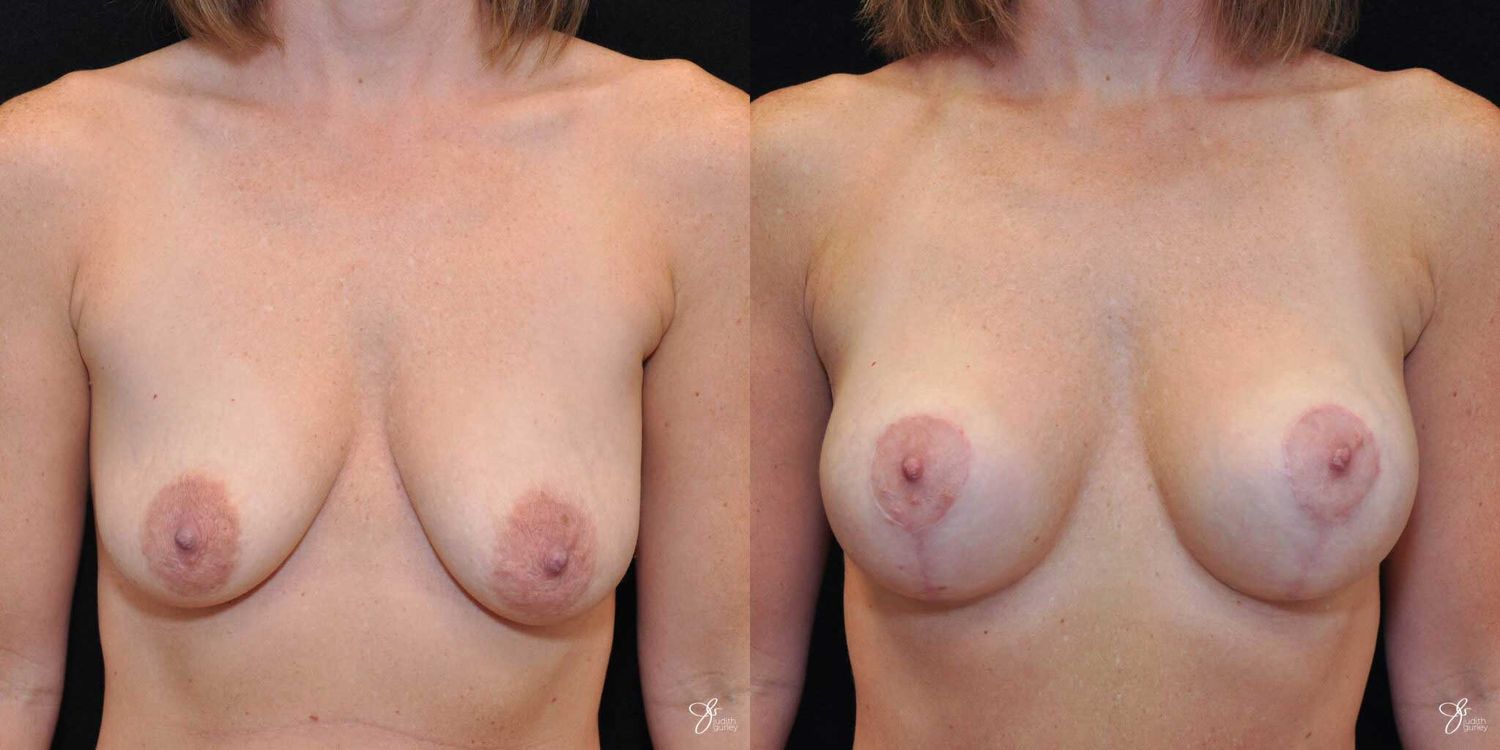 Breast Augmentation And Lift Before & After