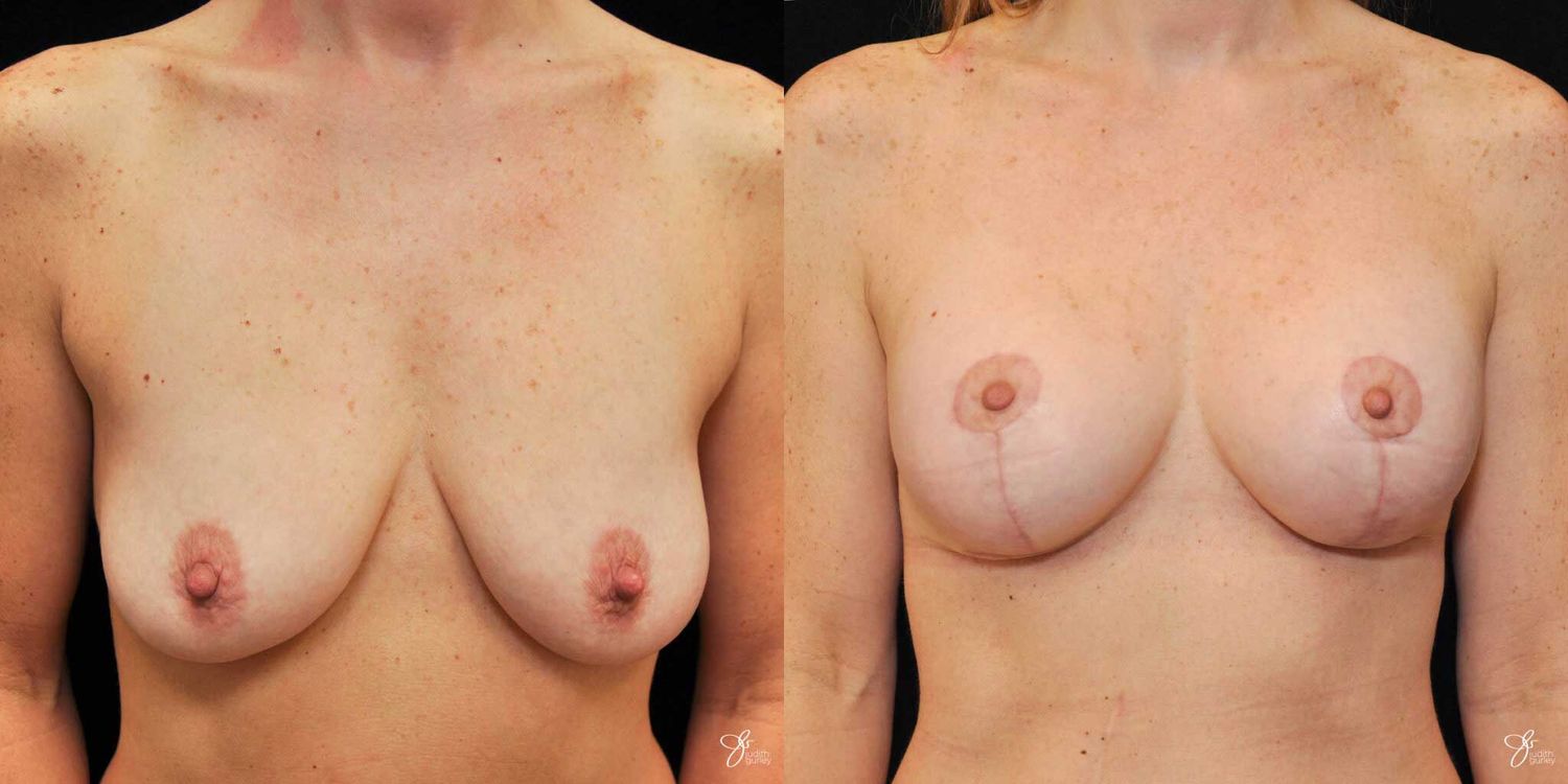 Breast Augmentation And Lift Before & After