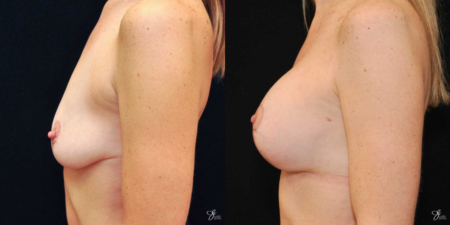 Breast Augmentation And Lift Before & After