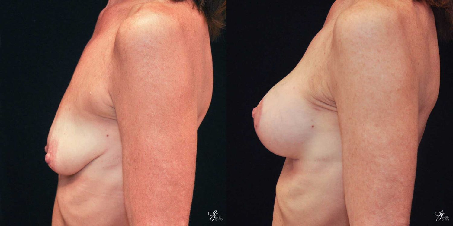 Breast Augmentation And Lift Before & After