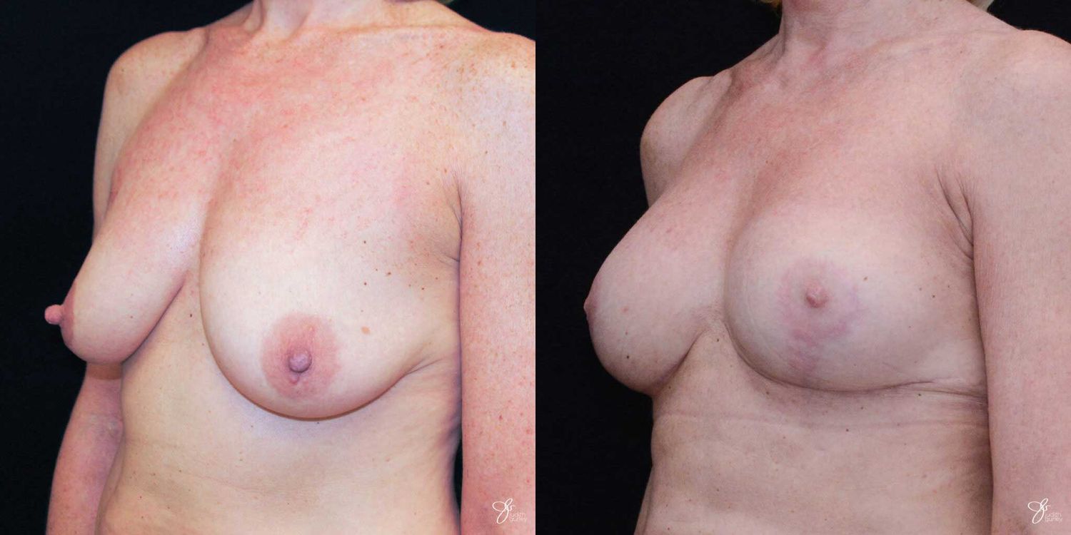 Breast Augmentation And Lift Before & After