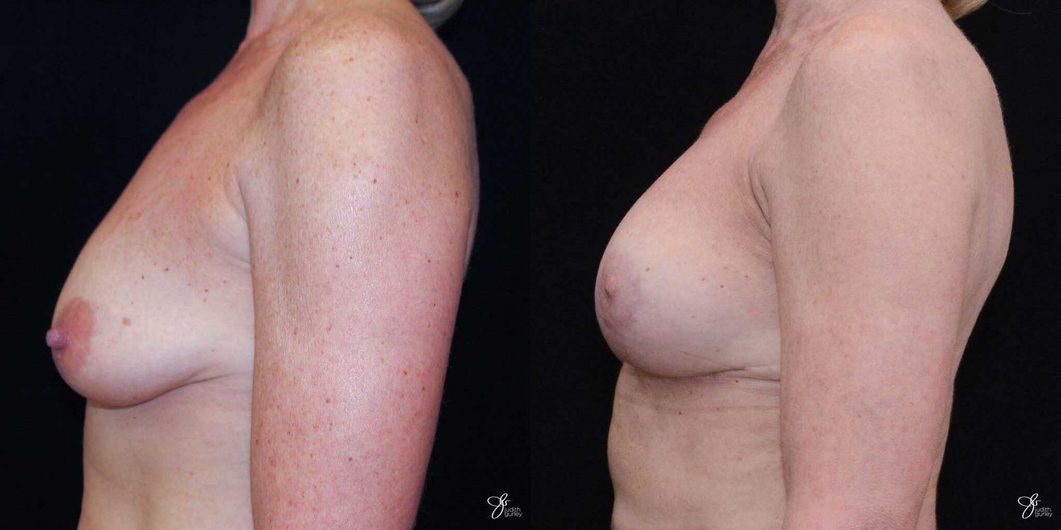Breast Augmentation And Lift Before & After
