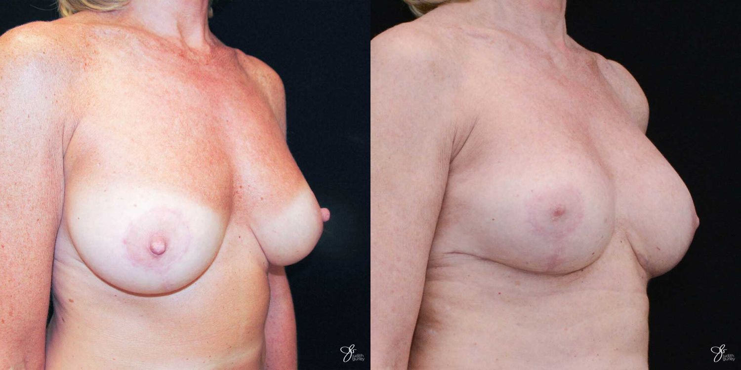Breast Augmentation And Lift Before & After