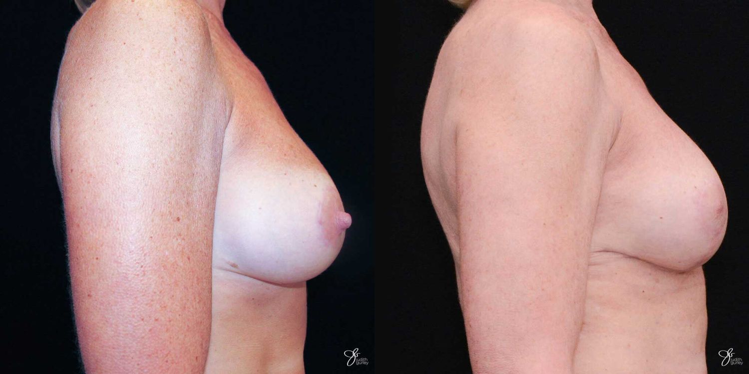 Breast Augmentation And Lift Before & After