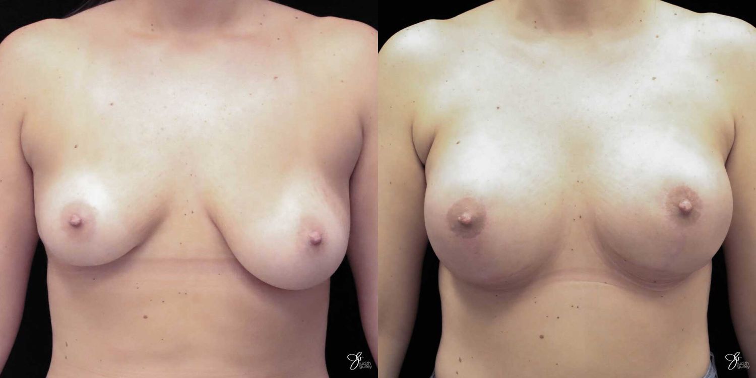 Breast Augmentation And Lift Before & After