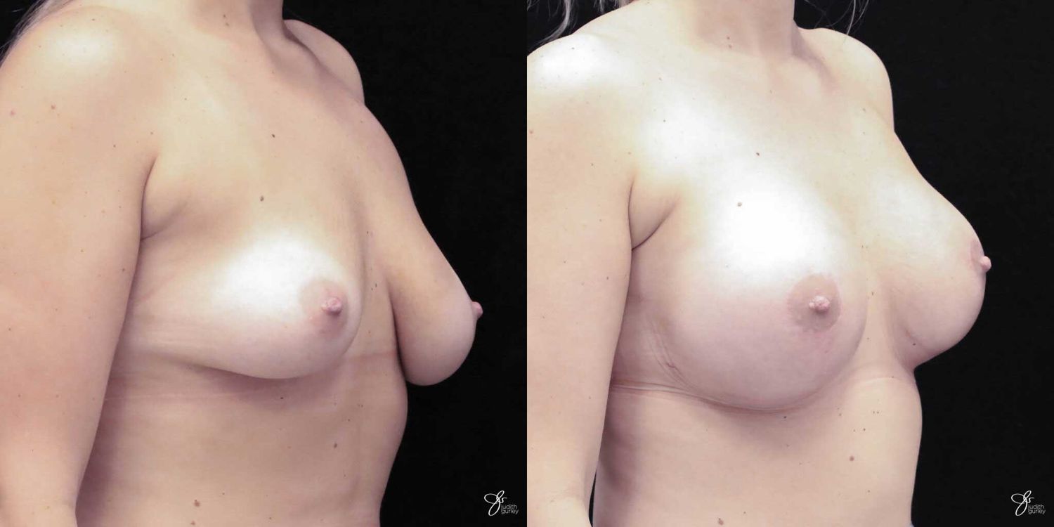 Breast Augmentation And Lift Before & After