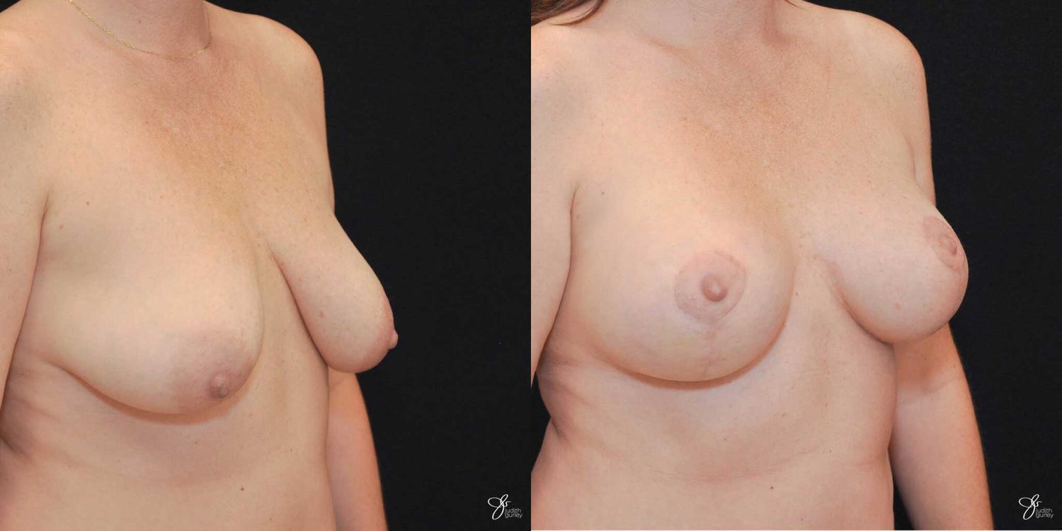 Breast Augmentation And Lift Before & After