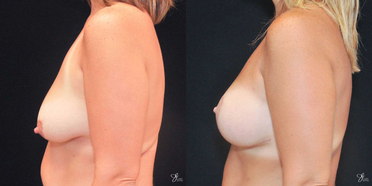 Breast Augmentation And Lift Before & After
