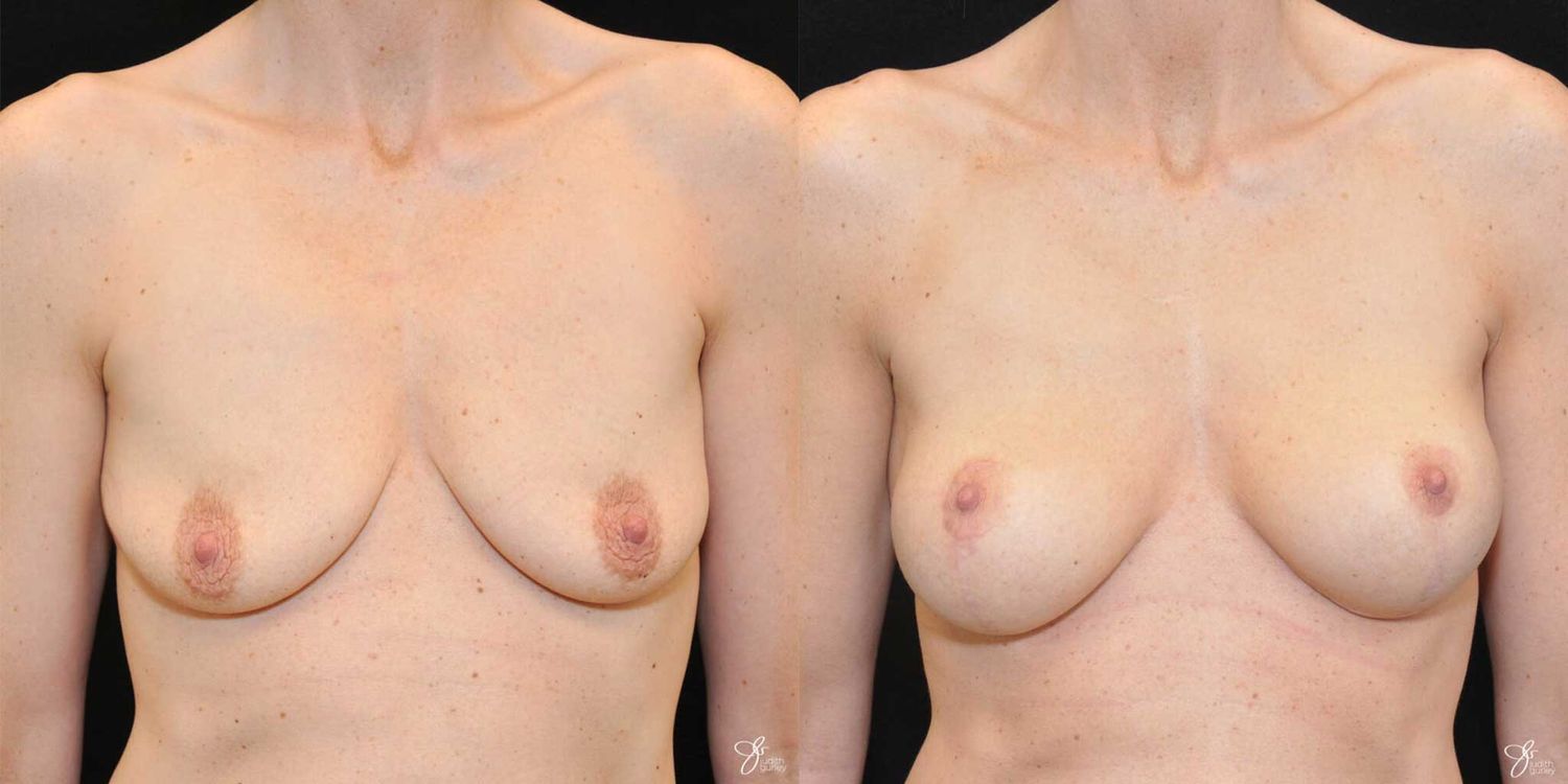 Breast Augmentation And Lift Before & After
