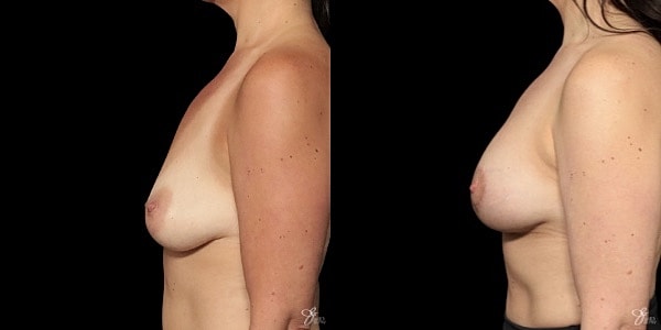 Breast Augmentation And Lift Before & After
